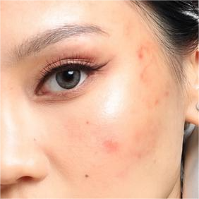 Acne ⟶