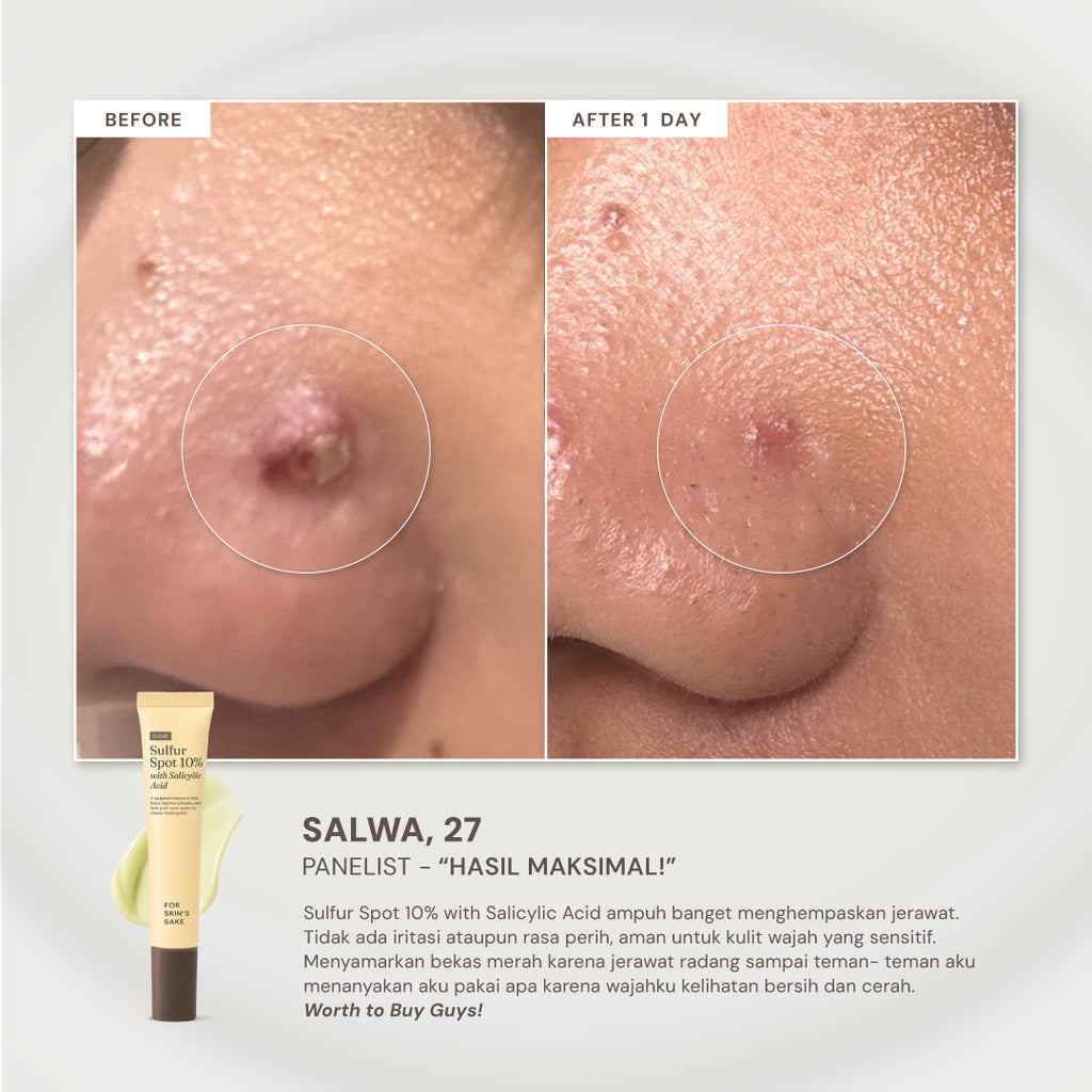 For Skin’s Sake FSS Sulfur Acne Spot 10% Acne Spot Obat Totol Jerawat Treatment dengan Salicylic Acid 2% + Niacinamide 4% untuk Membantu Mengempiskan Jerawat Aktif, Meradang, Kemerahan dan Mengontrol Minyak