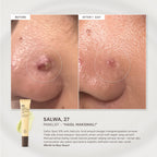 For Skin’s Sake FSS Sulfur Acne Spot 10% Acne Spot Obat Totol Jerawat Treatment dengan Salicylic Acid 2% + Niacinamide 4% untuk Membantu Mengempiskan Jerawat Aktif, Meradang, Kemerahan dan Mengontrol Minyak