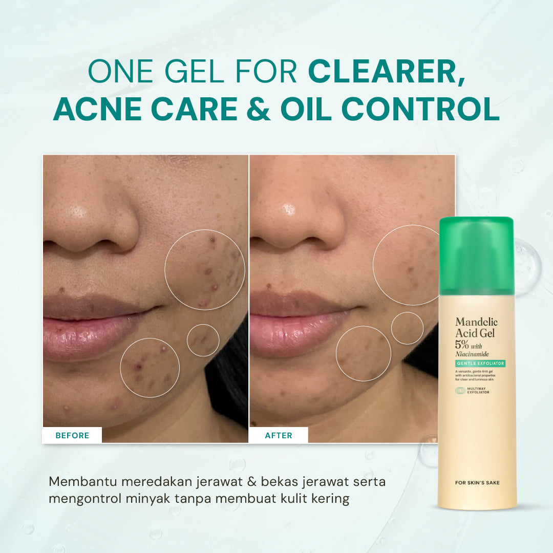 Mandelic Acid Gel 5% with Niacinamide