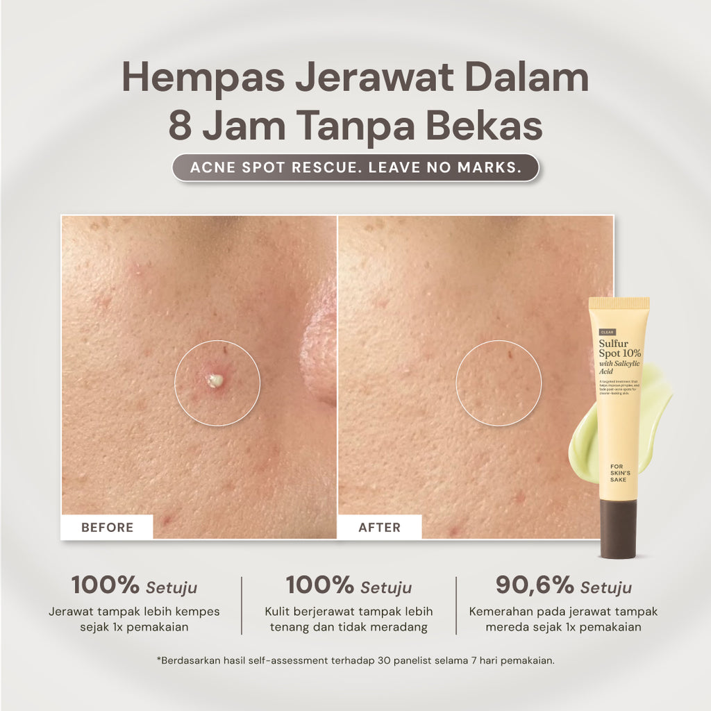 For Skin’s Sake FSS Sulfur Acne Spot 10% Acne Spot Obat Totol Jerawat Treatment dengan Salicylic Acid 2% + Niacinamide 4% untuk Membantu Mengempiskan Jerawat Aktif, Meradang, Kemerahan dan Mengontrol Minyak