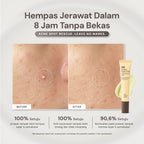 For Skin’s Sake FSS Sulfur Acne Spot 10% Acne Spot Obat Totol Jerawat Treatment dengan Salicylic Acid 2% + Niacinamide 4% untuk Membantu Mengempiskan Jerawat Aktif, Meradang, Kemerahan dan Mengontrol Minyak