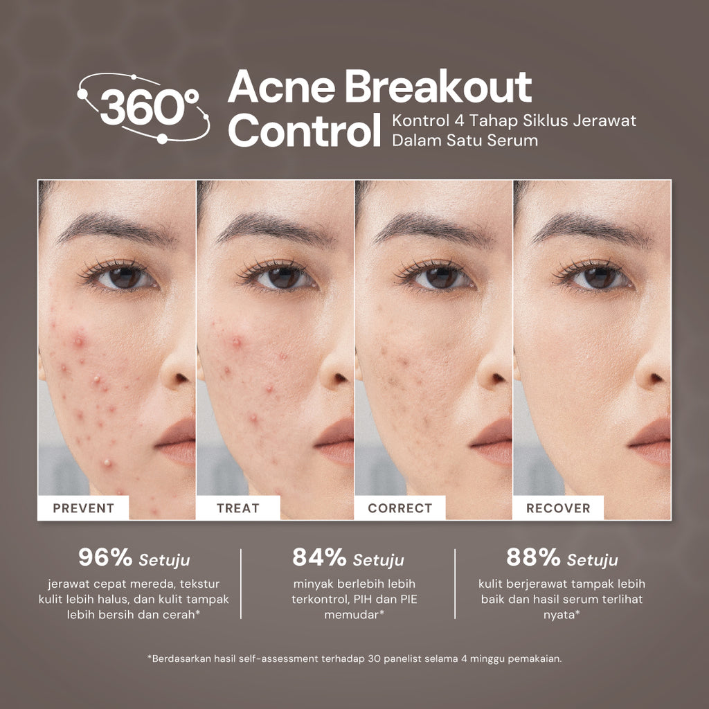 For Skin’s Sake FSS Dioic Acid Serum 2% with Azeclair 3.5% 30ml Acne Serum 360° Breakout Control Bantu Cegah dan Atasi Jerawat Berulang Kontrol Minyak serta Samarkan Bekas Jerawat PIE dan PIH
