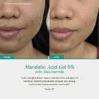 Mandelic Acid Gel 5% with Niacinamide