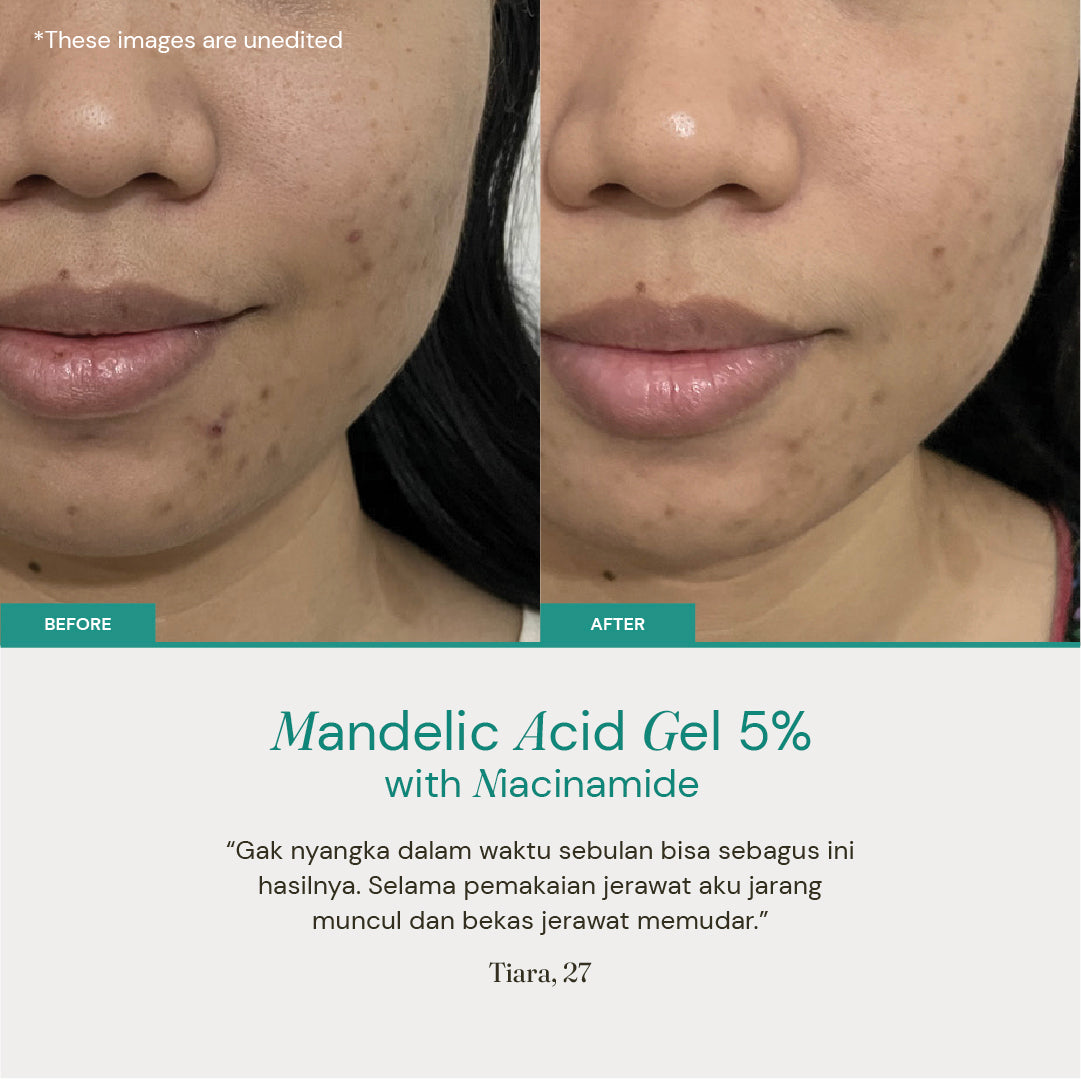 Mandelic Acid Gel 5% with Niacinamide