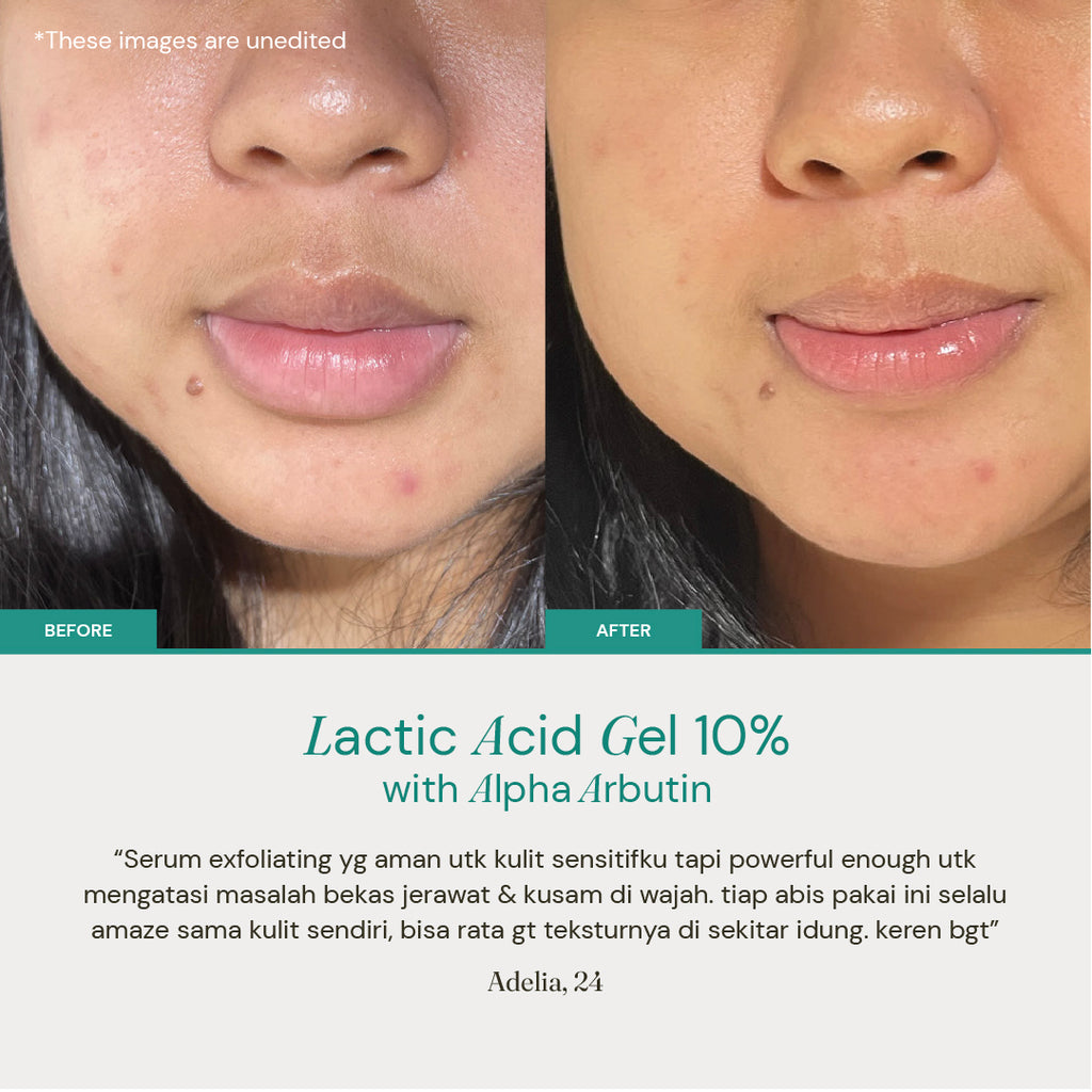 Lactic Acid Gel 10% with Alpha Arbutin