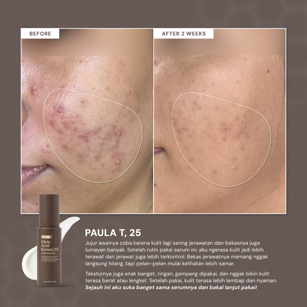 For Skin’s Sake FSS Dioic Acid Serum 2% with Azeclair 3.5% 30ml Acne Serum 360° Breakout Control Bantu Cegah dan Atasi Jerawat Berulang Kontrol Minyak serta Samarkan Bekas Jerawat PIE dan PIH