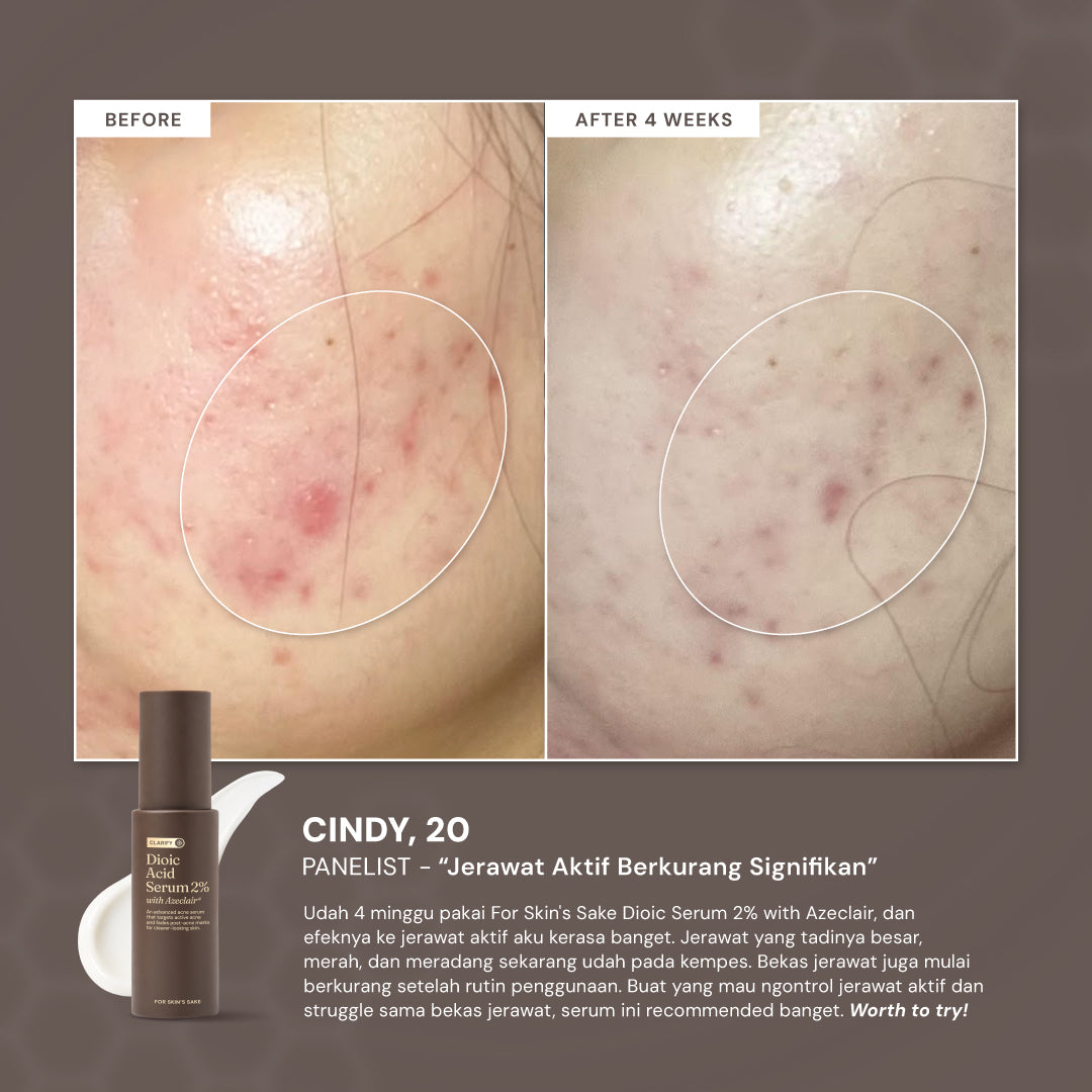 For Skin’s Sake FSS Dioic Acid Serum 2% with Azeclair 3.5% 30ml Acne Serum 360° Breakout Control Bantu Cegah dan Atasi Jerawat Berulang Kontrol Minyak serta Samarkan Bekas Jerawat PIE dan PIH