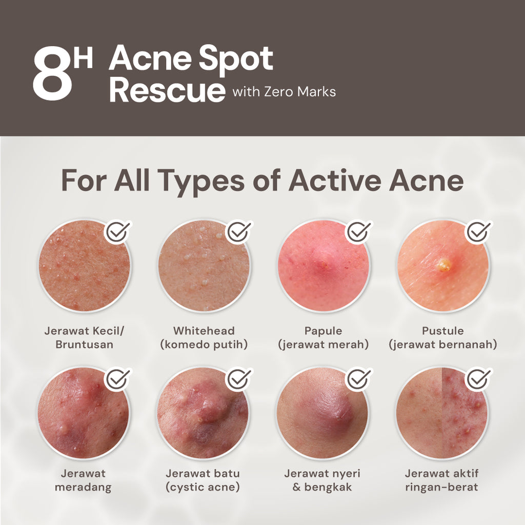 For Skin’s Sake FSS Sulfur Acne Spot 10% Acne Spot Obat Totol Jerawat Treatment dengan Salicylic Acid 2% + Niacinamide 4% untuk Membantu Mengempiskan Jerawat Aktif, Meradang, Kemerahan dan Mengontrol Minyak