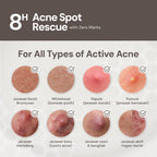 For Skin’s Sake FSS Sulfur Acne Spot 10% Acne Spot Obat Totol Jerawat Treatment dengan Salicylic Acid 2% + Niacinamide 4% untuk Membantu Mengempiskan Jerawat Aktif, Meradang, Kemerahan dan Mengontrol Minyak