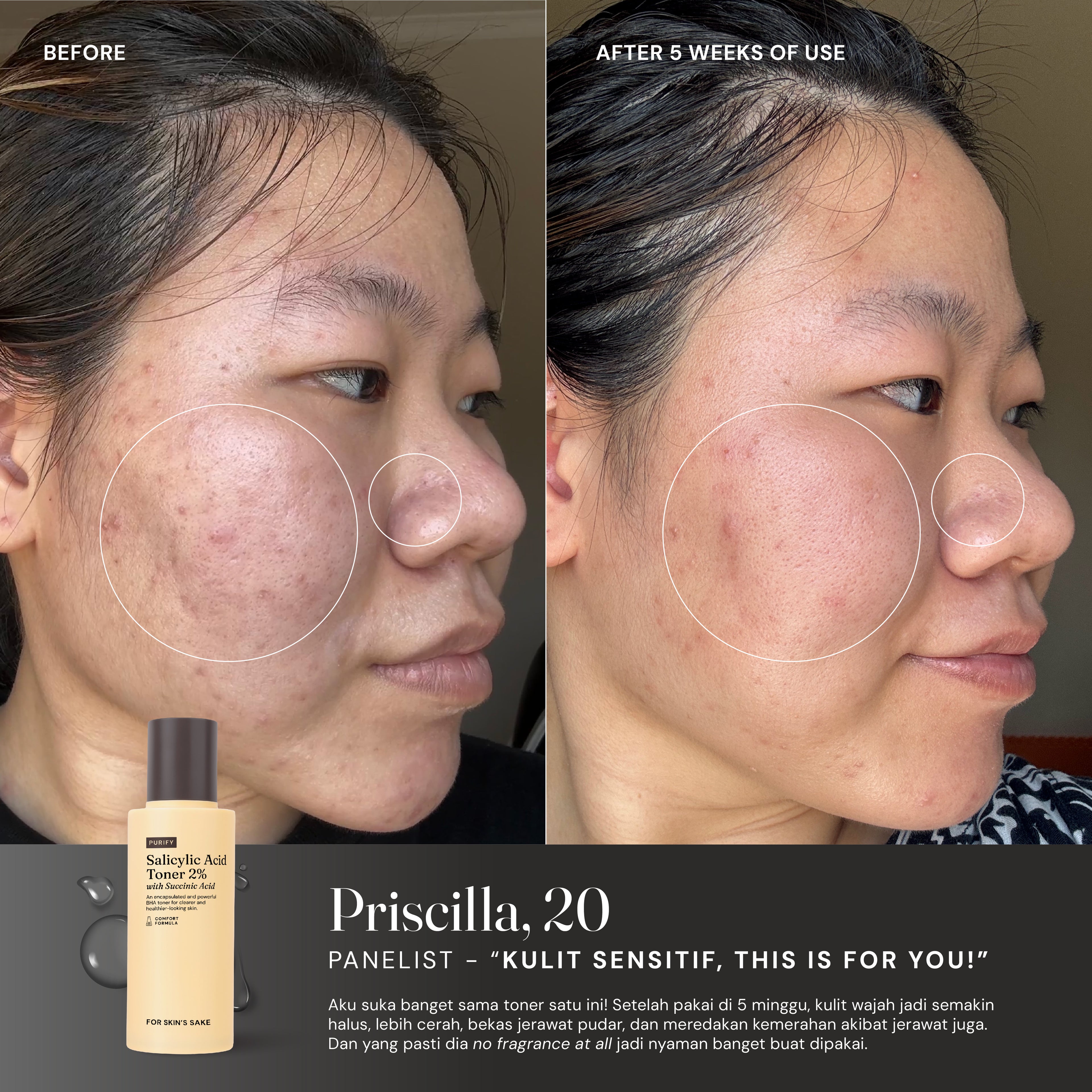 Salicylic Acid Toner 2% with Succinic Acid
